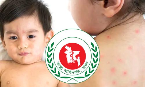 হাম ও উপসর্গ । ছবি: ক্যাপ্টেন্স টিভি