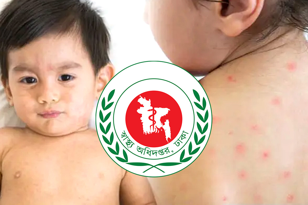 হাম ও উপসর্গ । ছবি: ক্যাপ্টেন্স টিভি